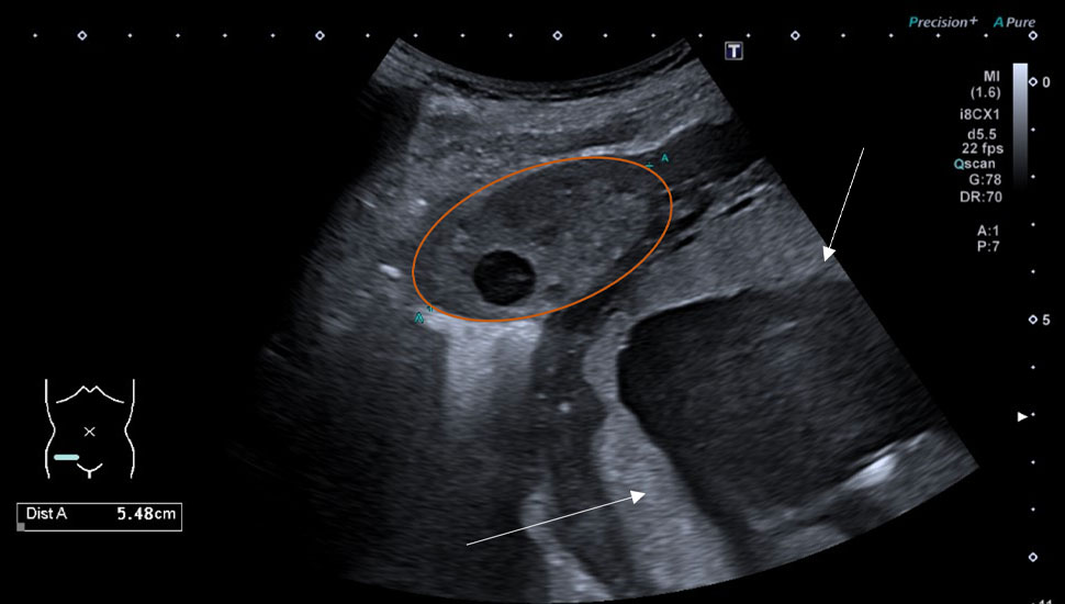 Acute buikpijn rechtsonder tijdens zwangerschap